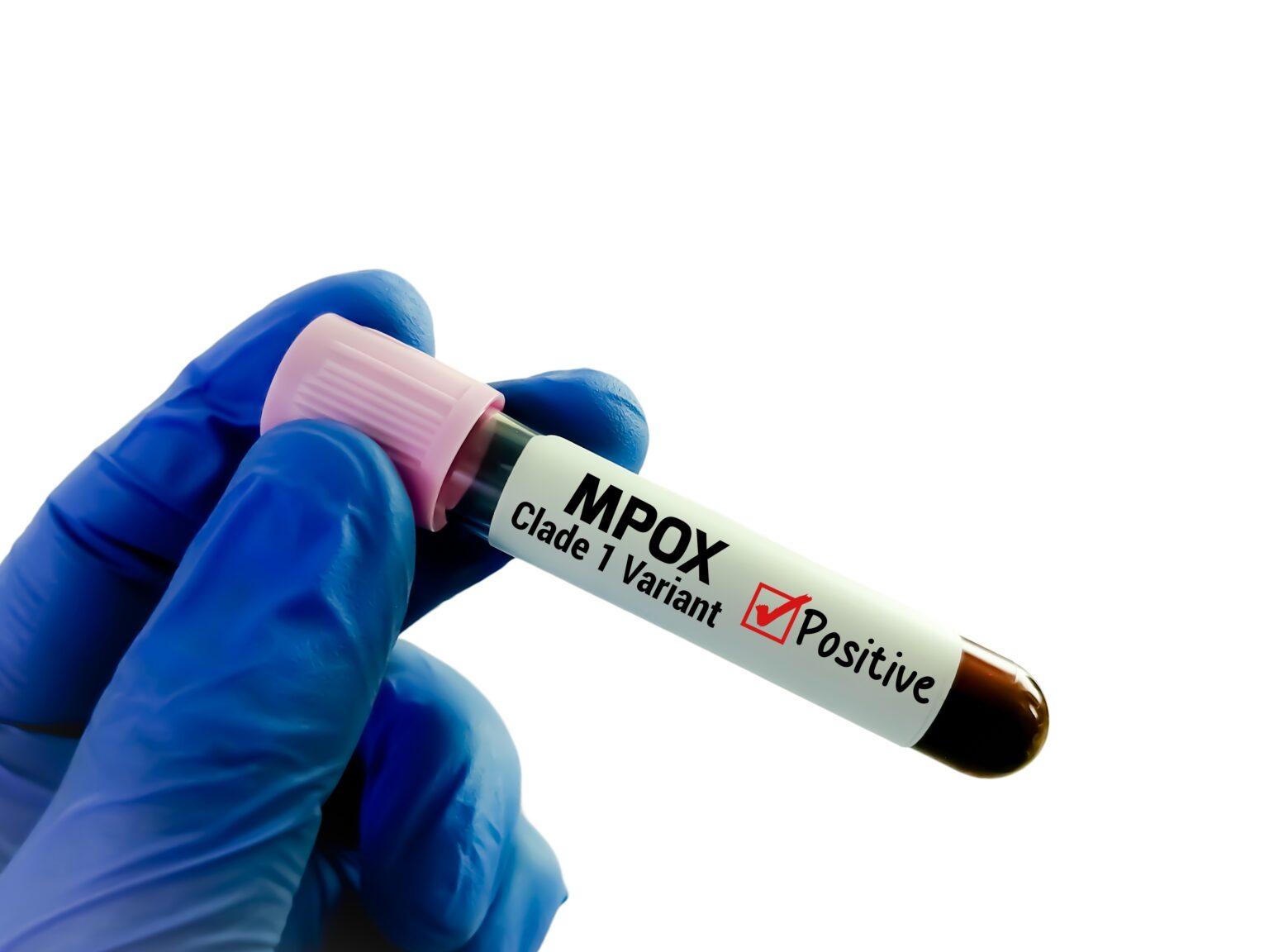 Madagascar mpox cases top 3,000 since outbreak in December 2025