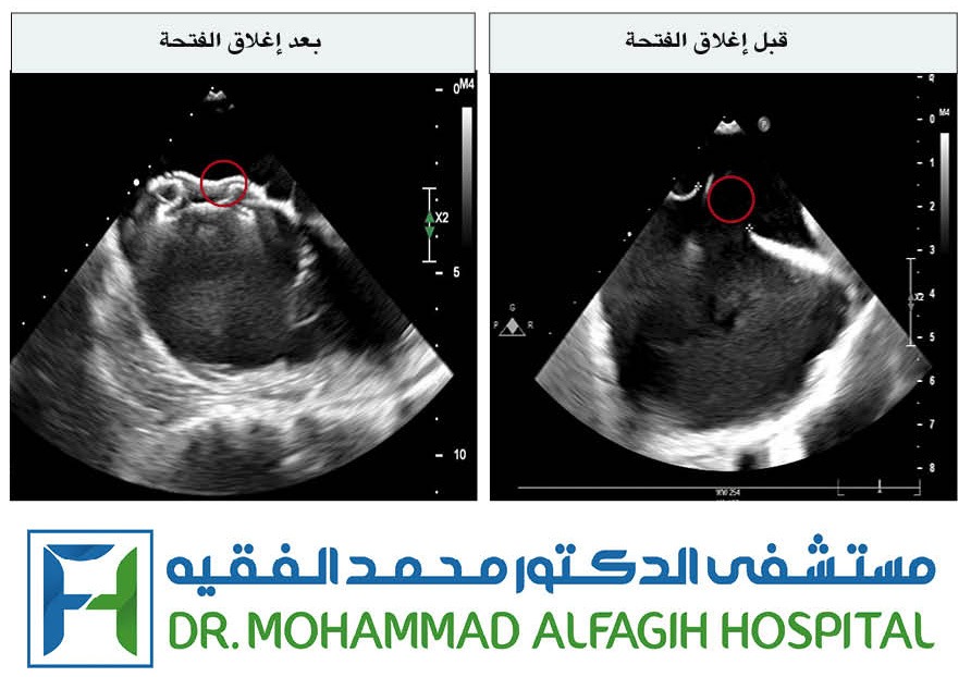إغلاق فتحة داخلية خلقية في القلب بدون جراحة في مستشفى الدكتور محمد الفقيه