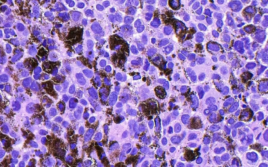 Breakthrough cancer vaccine cuts risk of skin cancer recurrence by almost half